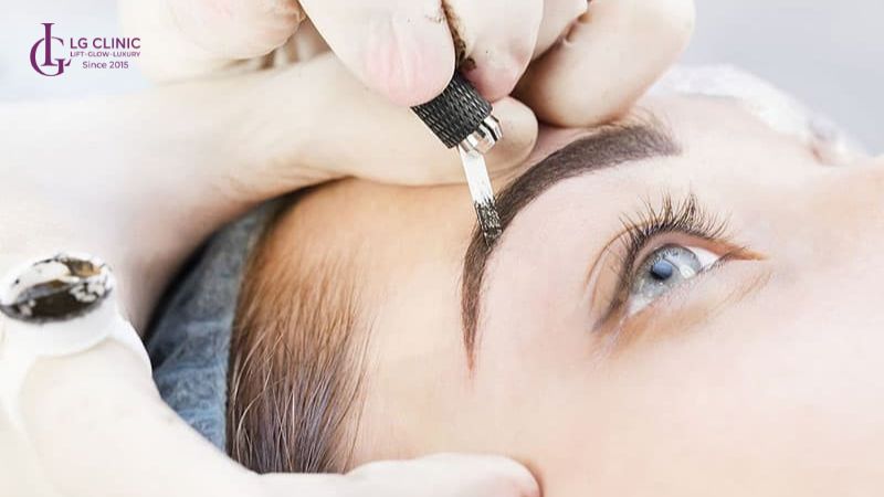 Khắc phục 2 chân mày xa nhau bằng điêu khắc thẩm mỹ