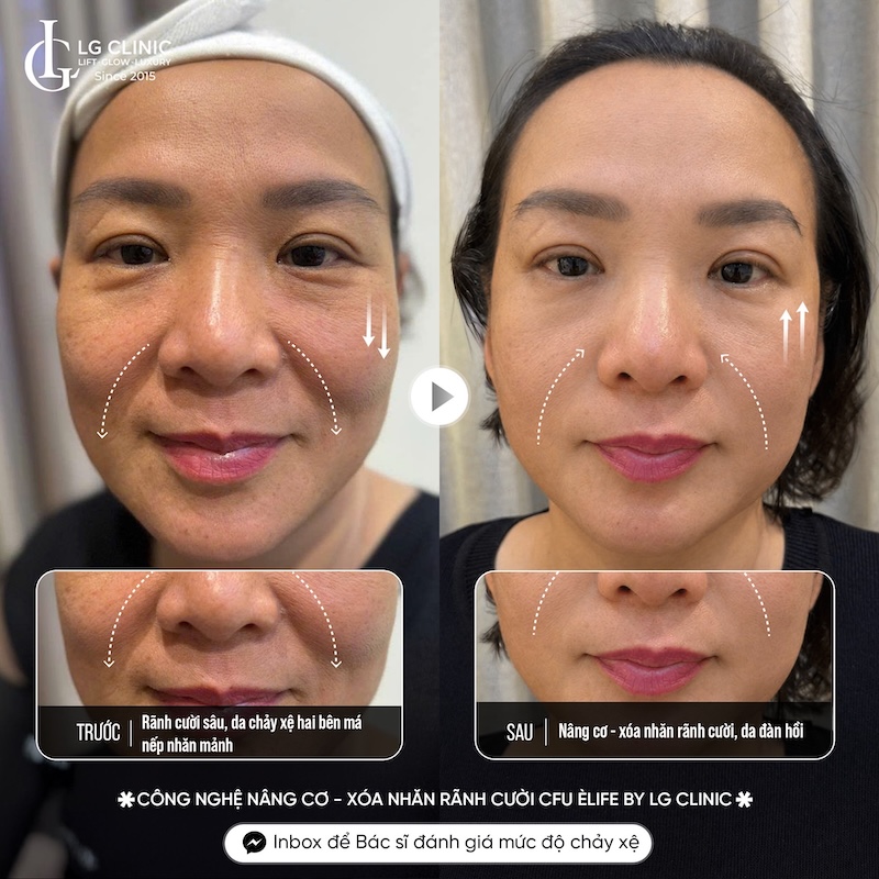 xoá nếp nhăn quanh miệng