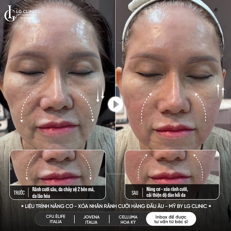 xoá rãnh cười bằng công nghệ 5.5.10