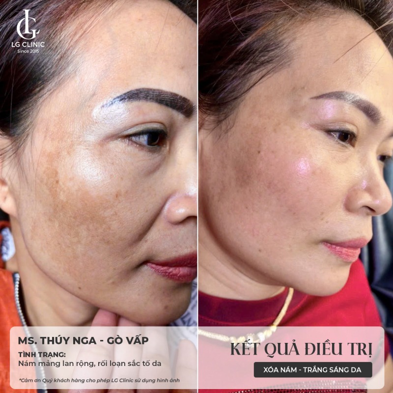 bắn tia laser trị nám
