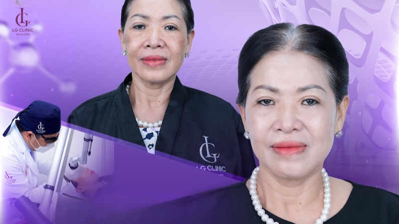bắn tia laser trị nám