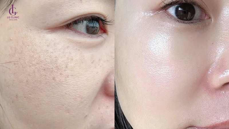 bắn tia laser trị nám