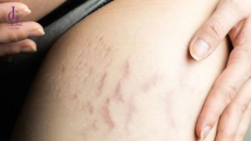 cách trị rạn da tại nhà