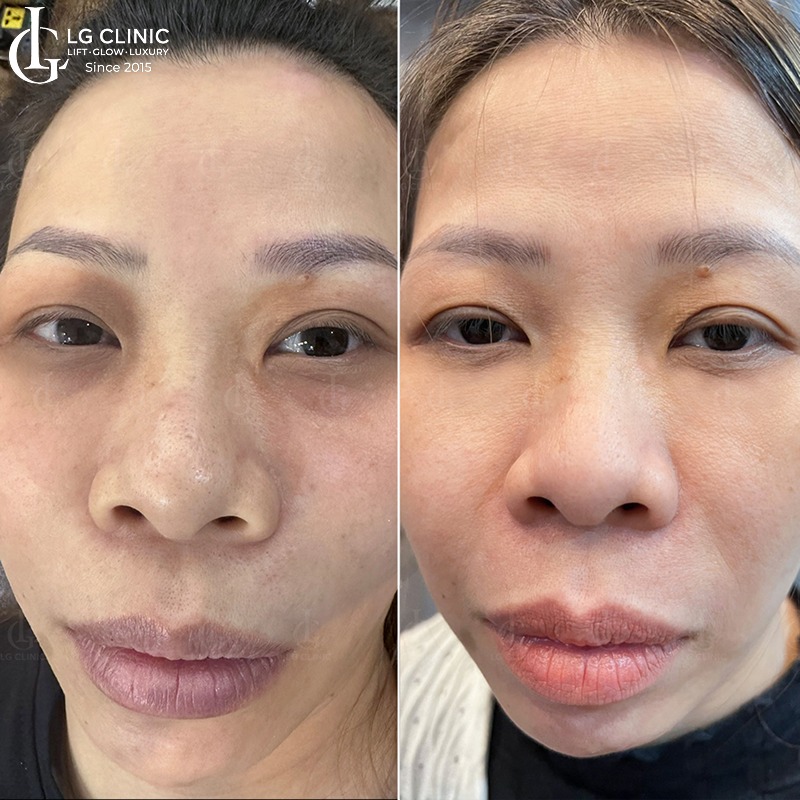 cách trị thâm quầng mắt bằng kem đánh răng
