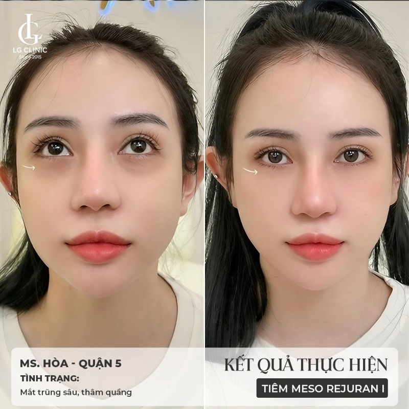 cách trị thâm quầng mắt bằng kem đánh răng