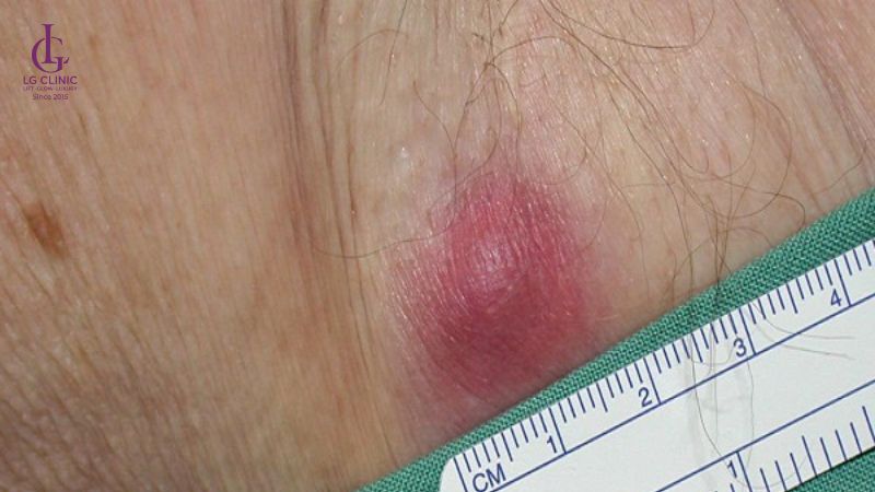 cách trị viêm lỗ chân lông ở nách