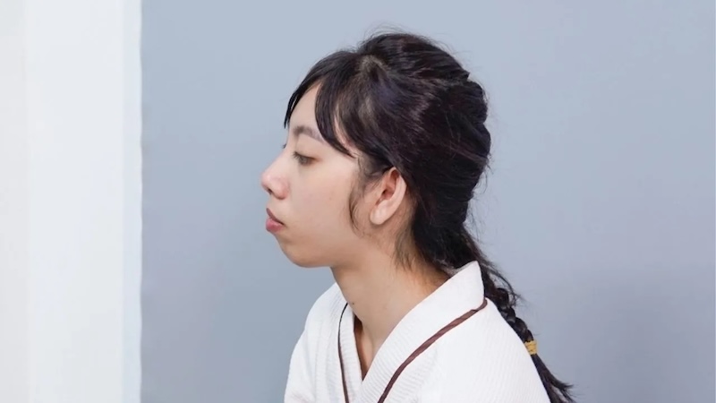 cằm lẹm