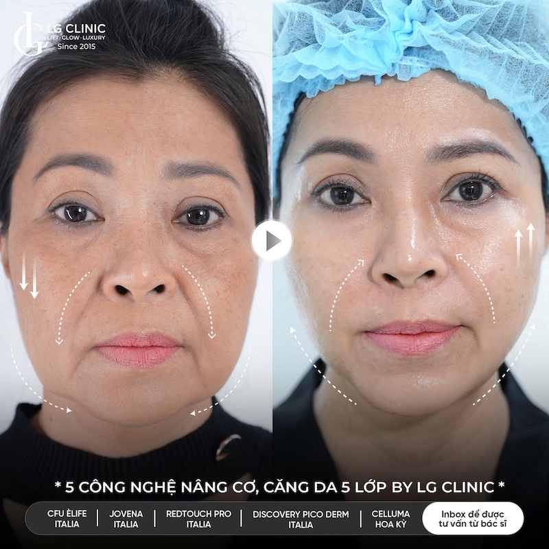 công nghệ trẻ hoá da 5.5.10
