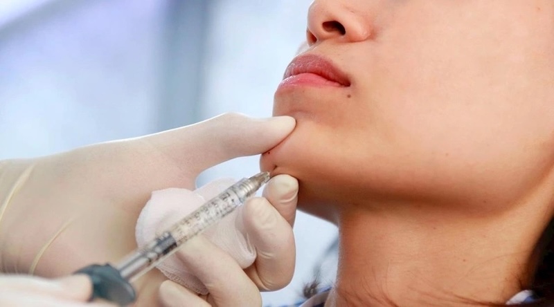 tiêm filler cằm
