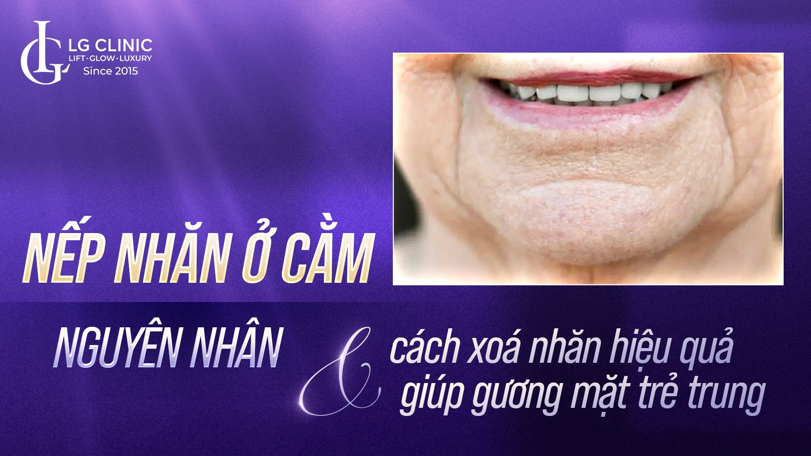 Nếp nhăn ở cằm: Nguyên nhân & cách xoá nhăn hiệu quả