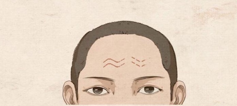 nếp nhăn trán hình vân rắn