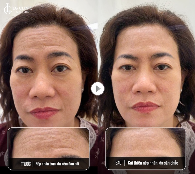 xoá nếp nhăn trên trán