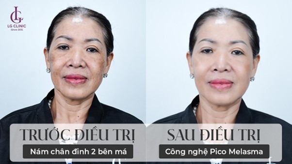 Quy Trình Trị Nám