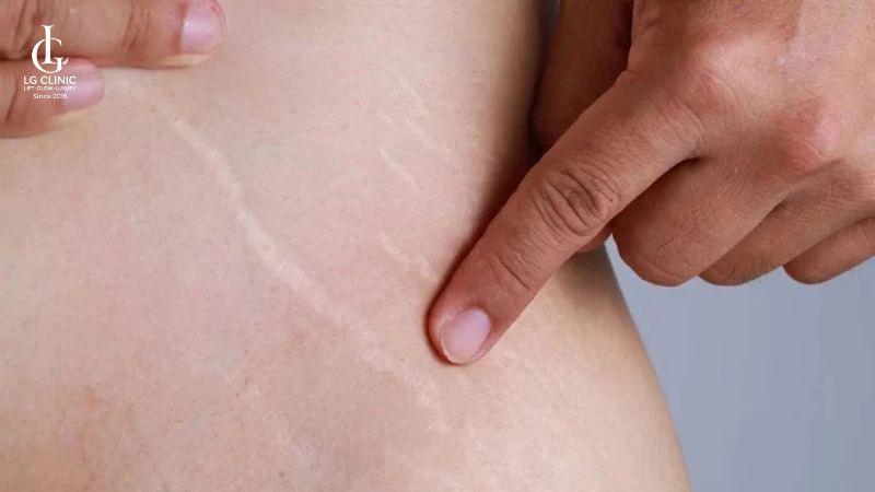 rạn da có chữa được không