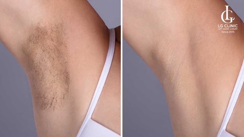 Sáp wax lông nách nào tốt nhất