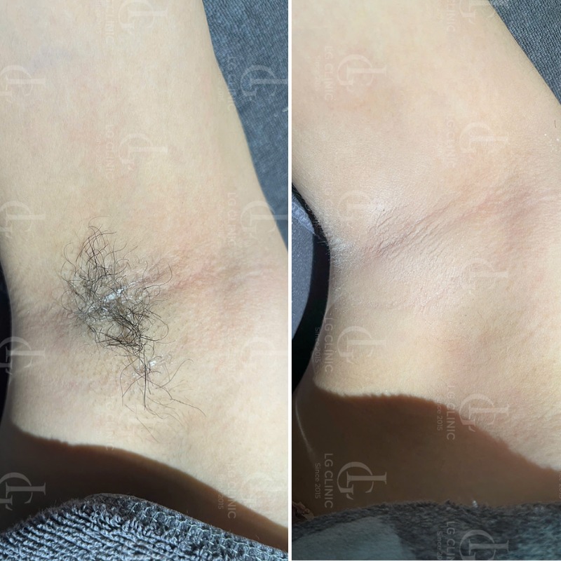 Sáp wax lông nách nào tốt nhất