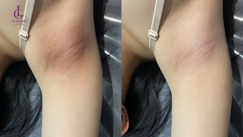spa trị thâm quận 9