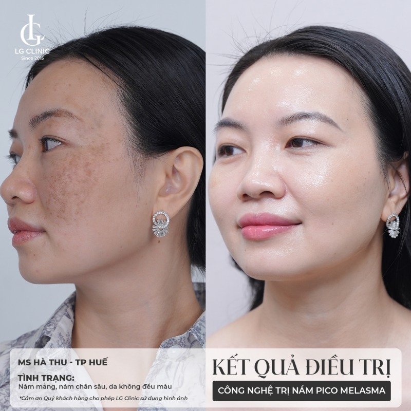 trị nám bằng laser bao nhiêu tiền