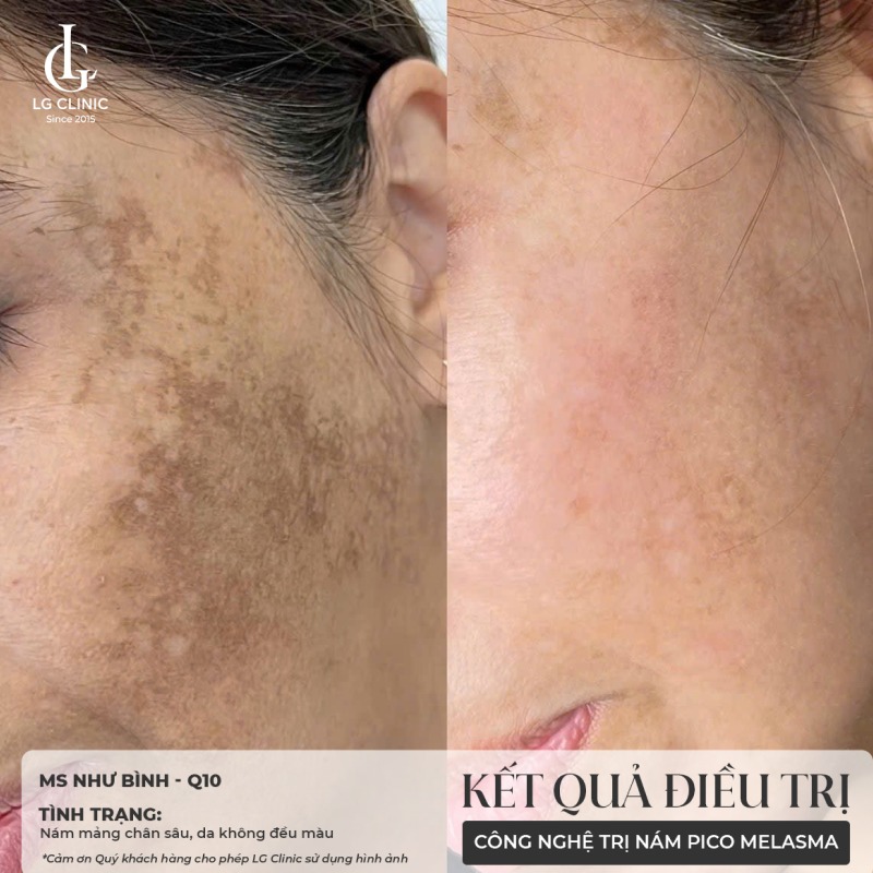 trị nám bằng laser bao nhiêu tiền