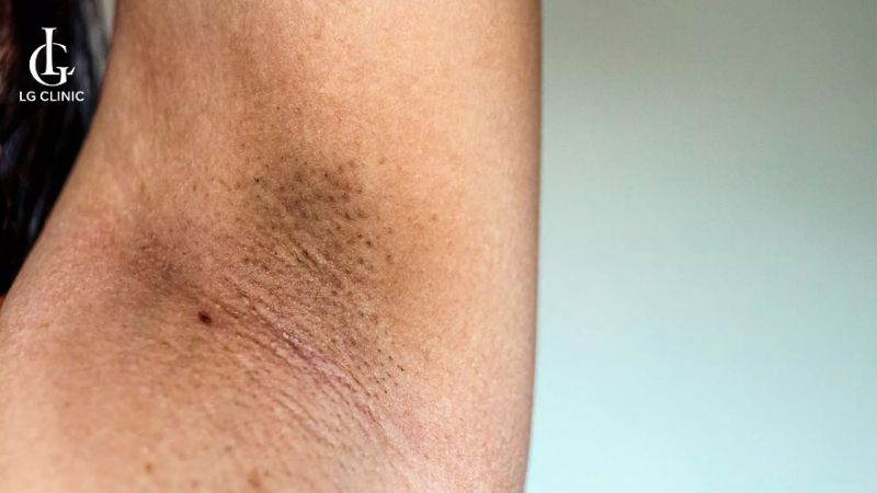trị thâm nách mất bao lâu