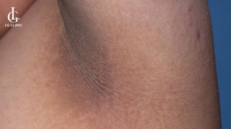 trị thâm nách mất bao lâu