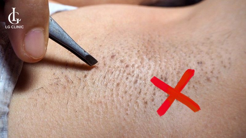 trị thâm nách mất bao lâu