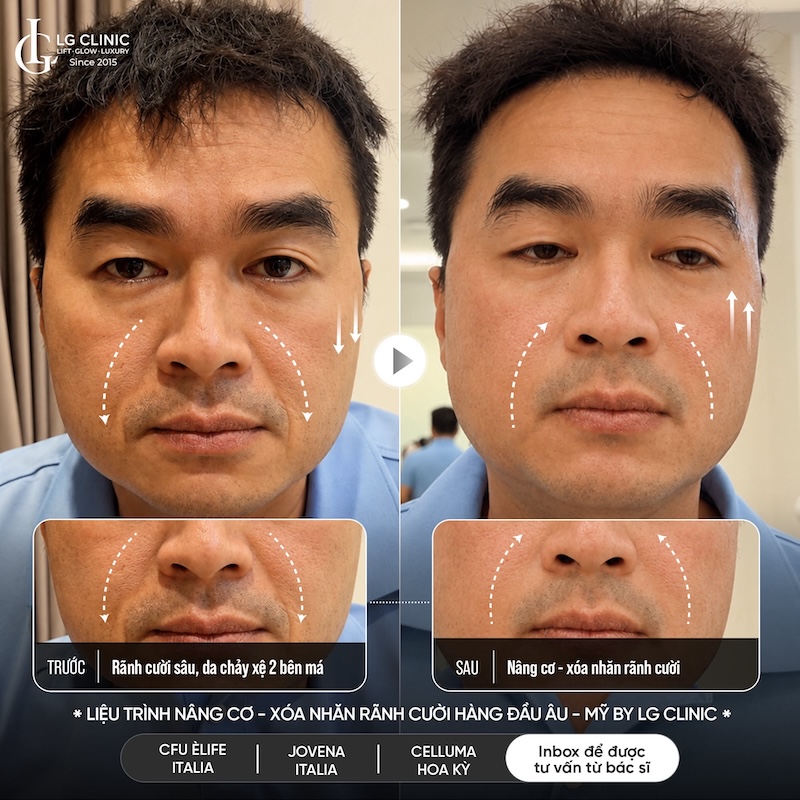 xoá rãnh cười tại lg clinic
