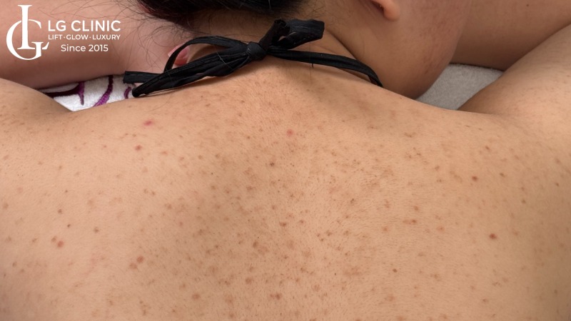 viêm nang lông ở lưng