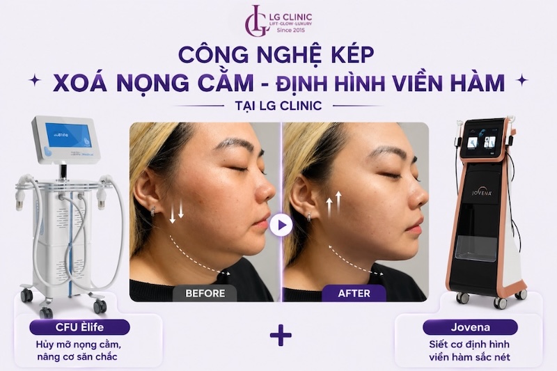 xoá nọng cằm tại lg clinic