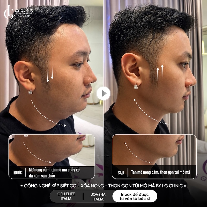 giảm nọng cằm tại lg clinic