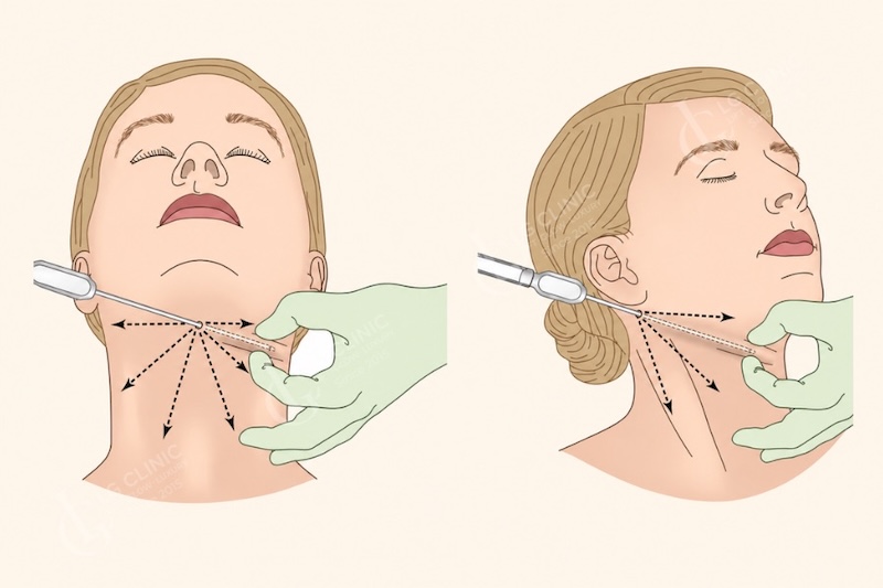 hút mỡ nọng cằm