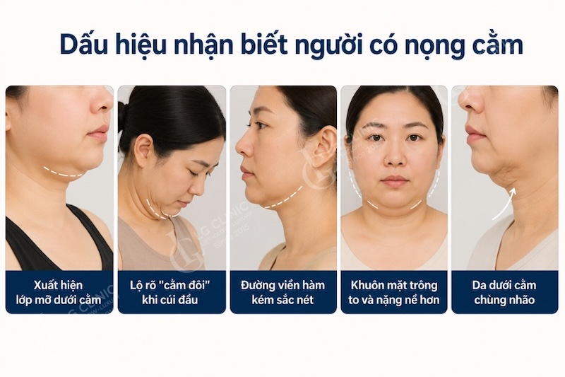 người có nọng cằm