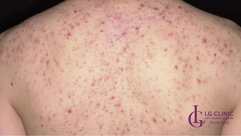 cách trị mụn lưng sau sinh