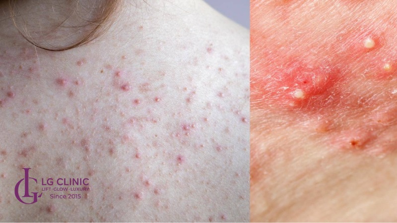 cách trị mụn lưng sau sinh