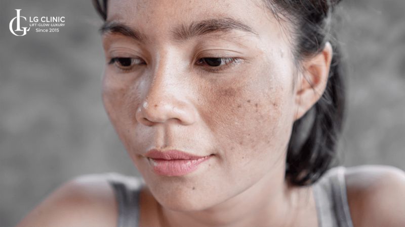 cách trị nám cho bà bầu