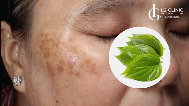 cách trị nám sau sinh