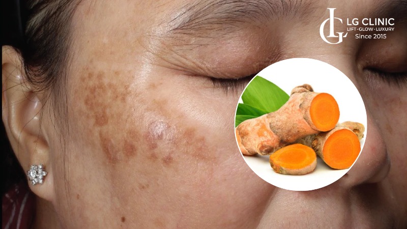 cách trị nám sau sinh