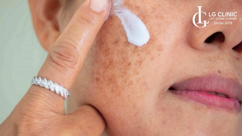 cách trị nám sau sinh