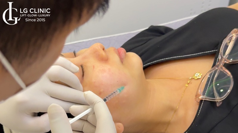 điều trị nám da