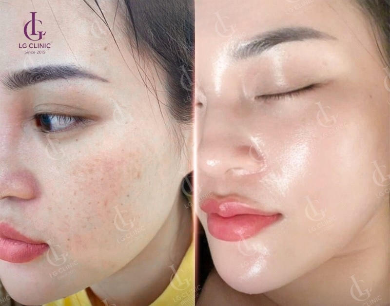 điều trị nám da