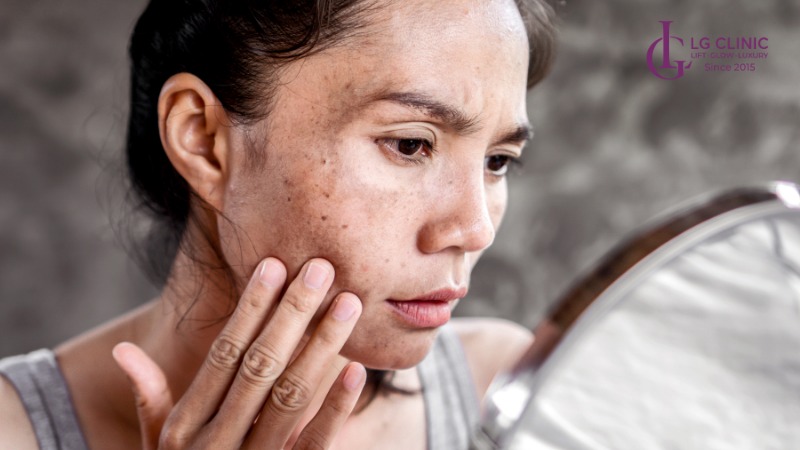 điều trị nám da