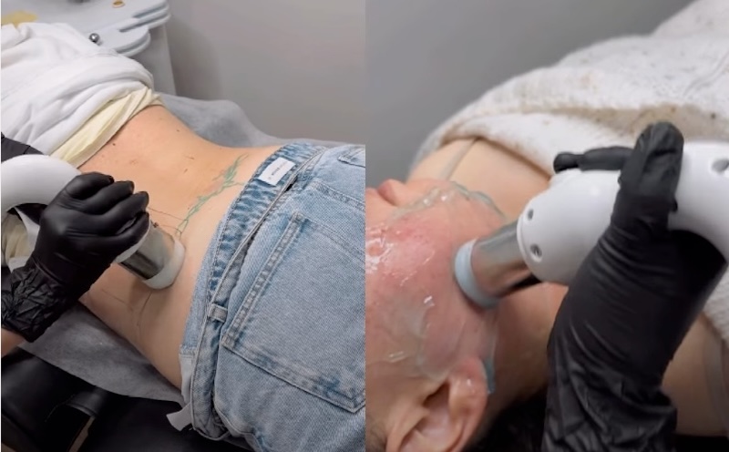 giảm béo không xâm lấn bằng cfu èlife