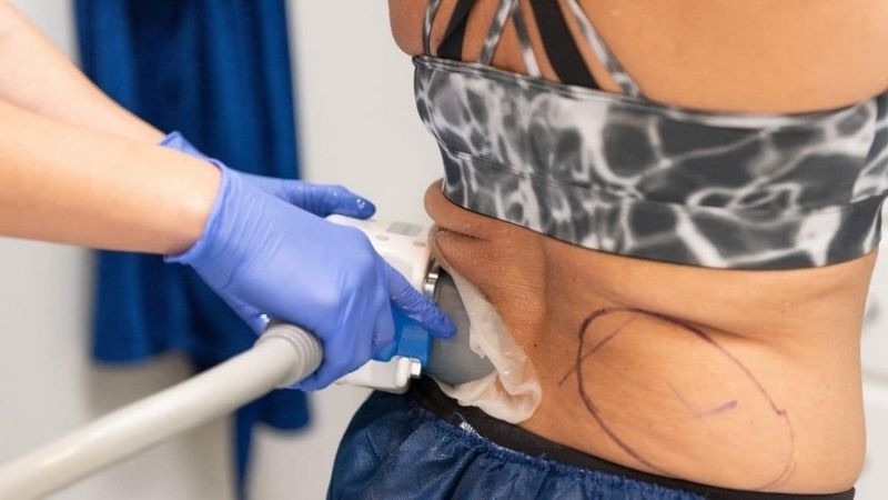 giảm mỡ bằng công nghệ không xâm lấn