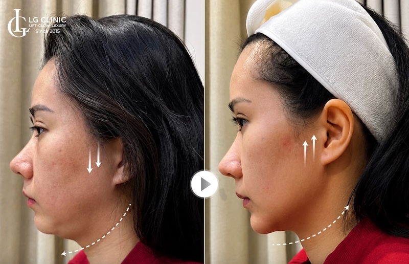 giảm mỡ nọng cằm