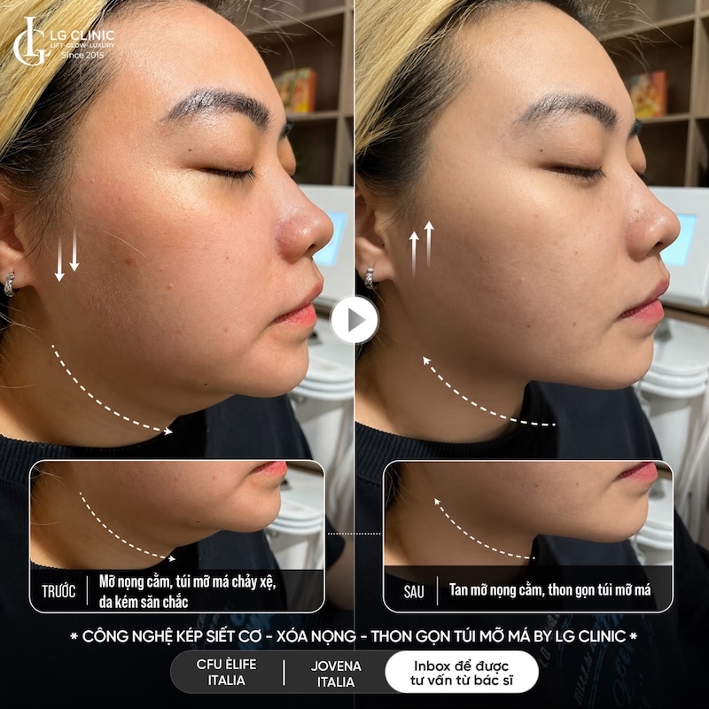 giảm mỡ nọng cằm