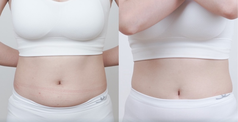 giảm mỡ bụng không xâm lấn