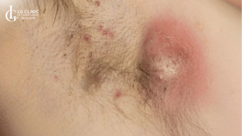 Hình ảnh viêm nang lông ở nách