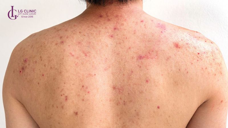 mụn trứng cá ở lưng
