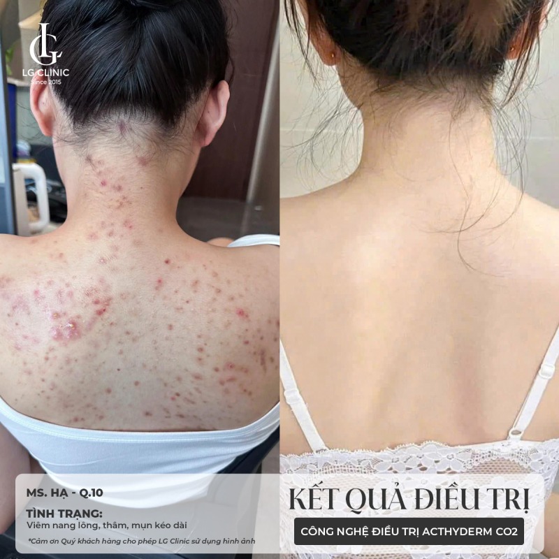 mụn trứng cá ở lưng 
