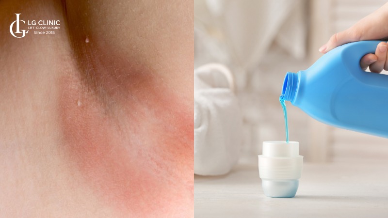 nách bị ngứa rát